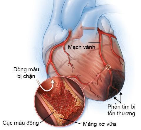 nguyên nhân gây nhồi máu cơ tim