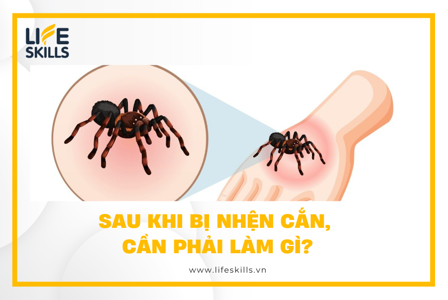 Sau khi bị nhện cắn, cần phải làm gì?