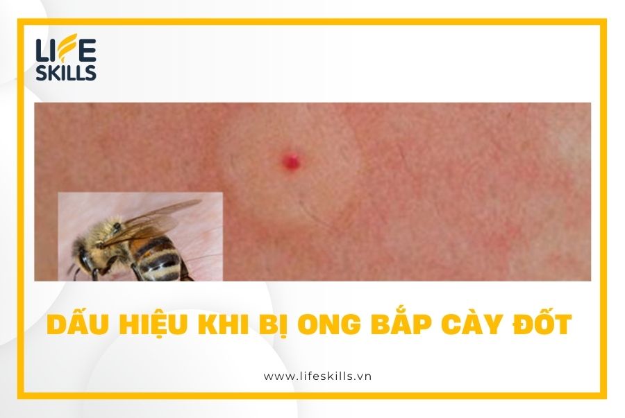 Dấu hiệu khi bị ong bắp cày đốt