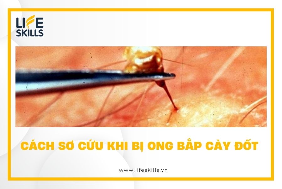 Cách sơ cứu khi bị ong bắp cày đốt